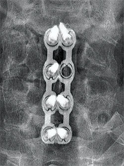RPR-Cervical-Spine-
