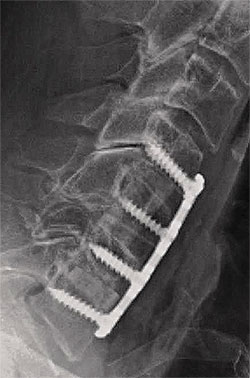 RPR-Cervical-Spine-PT-File-